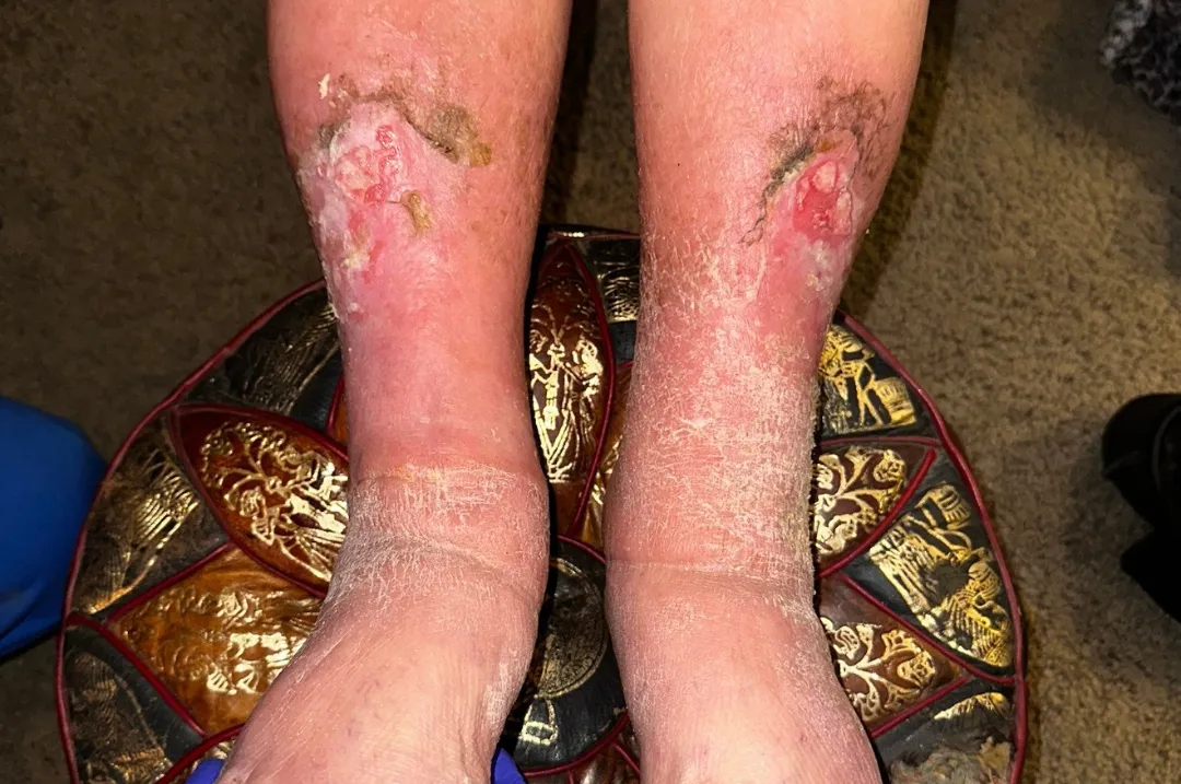 Venous Stasis Ulcers